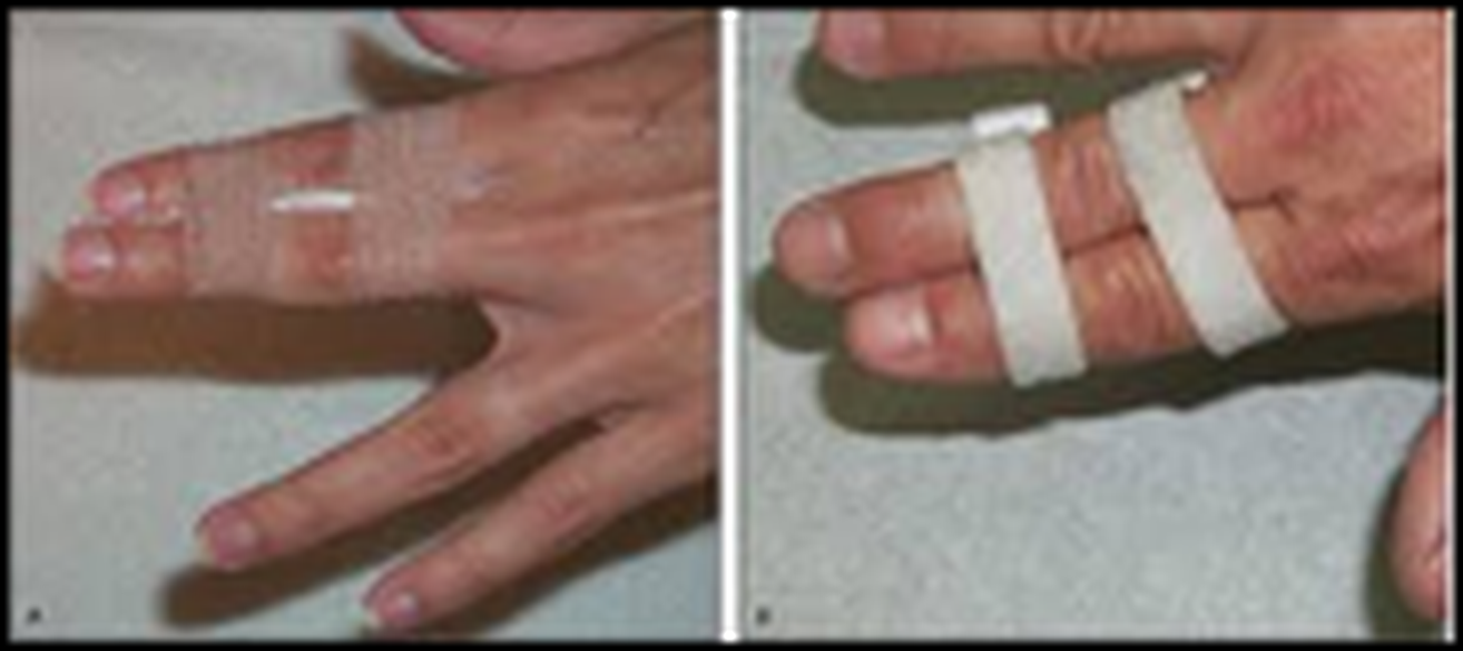 sprained-finger-taping-i-how-to-tape-your-sprained-finger-youtube