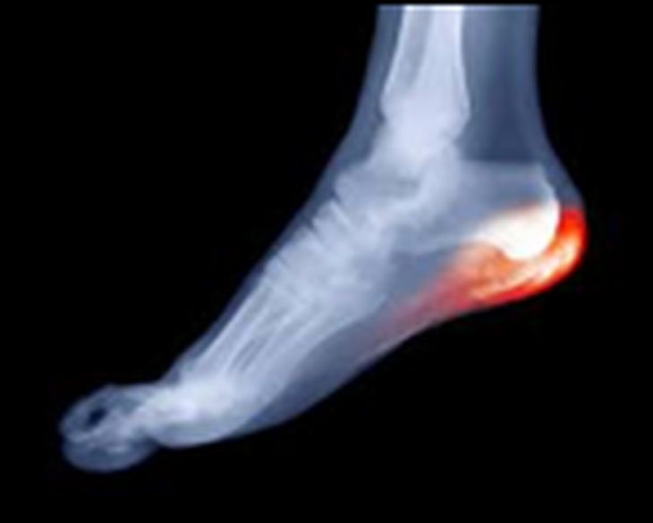 bruised heel bone