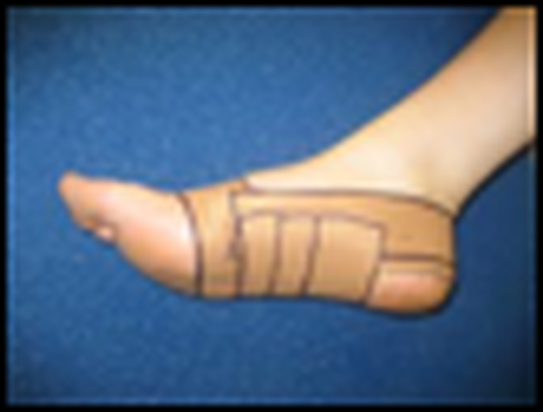 foot strapping for plantar fasciitis